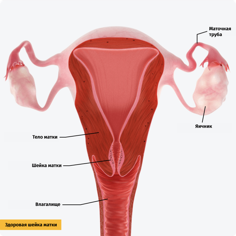 Нормальная шейка матки со слизистой оболочкой без изменений.