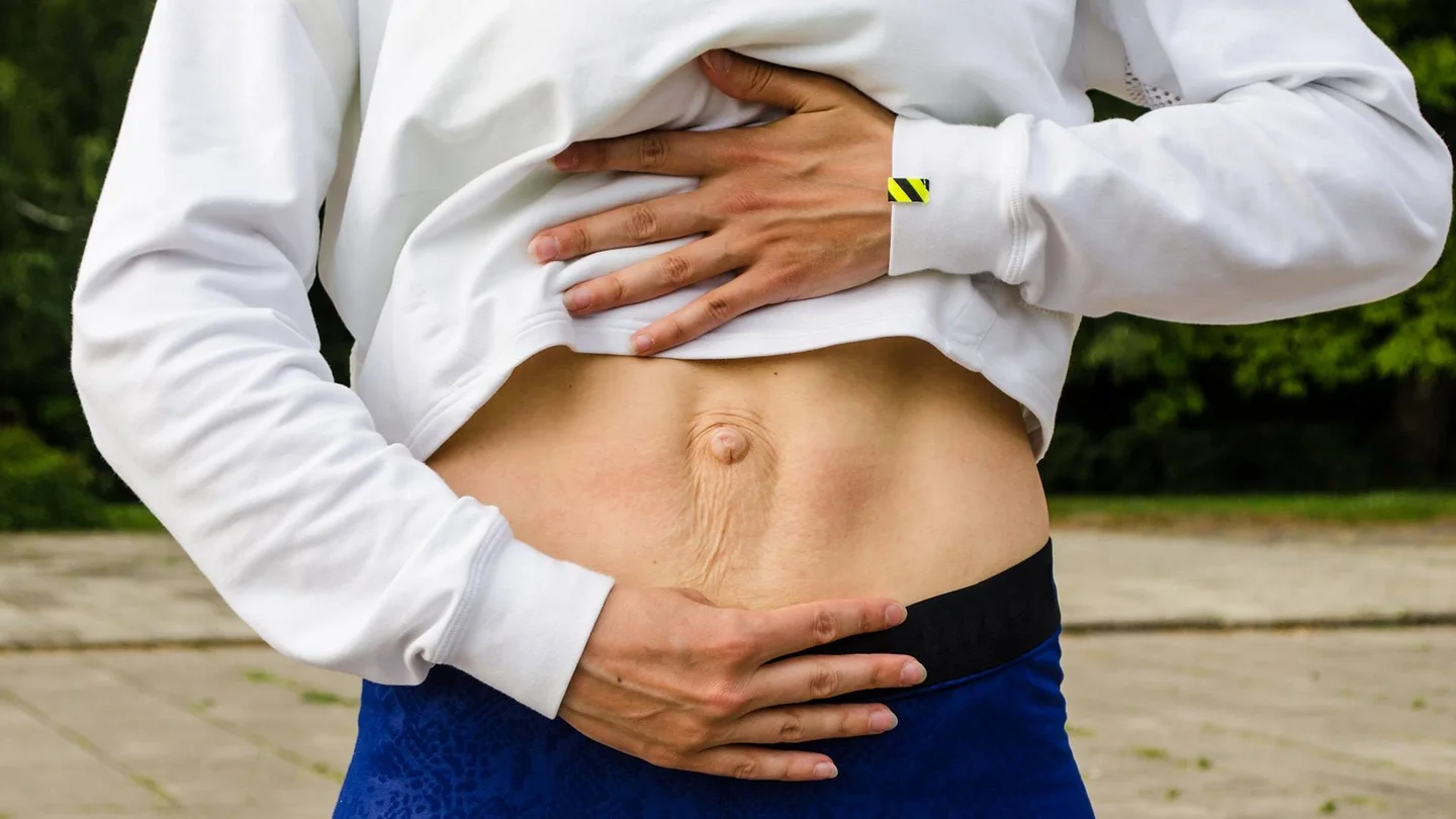 Bauch einer Person: Beidseits vom Nabel verlaufen senkrecht die Muskelstr&auml;nge, die auseinanderweichen und einen Spalt bilden.