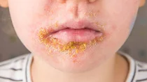 Impetigo contagiosa: Borkenflechte am Mund eines Jungen.