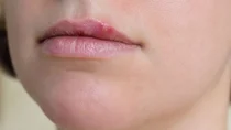 Herpes labialis: Eine junge Frau hat Fieberblasen an ihrer Oberlippe.