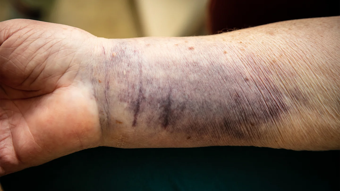 Senile Purpura: Das Handgelenk einer &auml;lteren Person weist einen gro&szlig;fl&auml;chigen blau-violetten Flecken auf.
