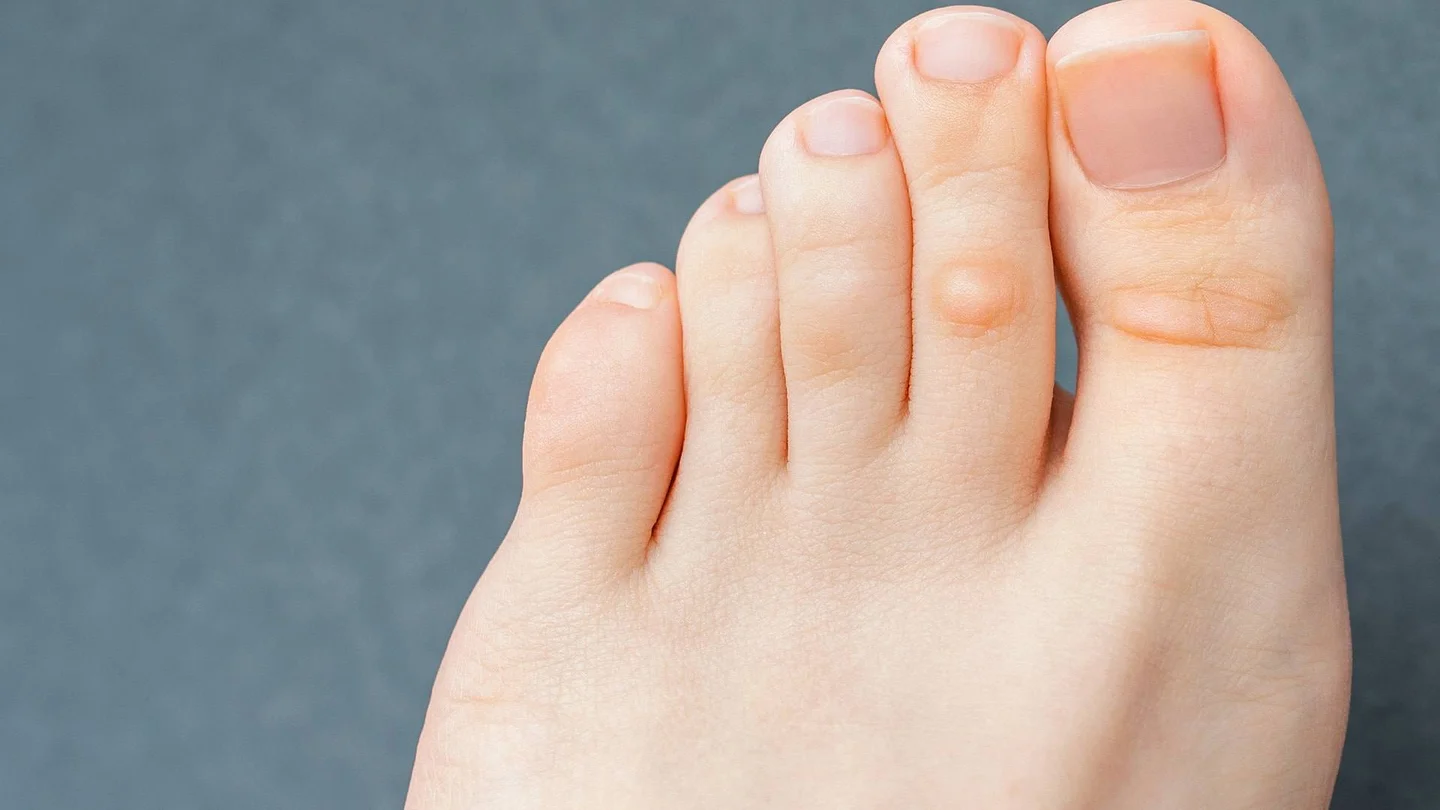 Ein Fuß, an dessen Zeh sich ein Hühnerauge andeutet