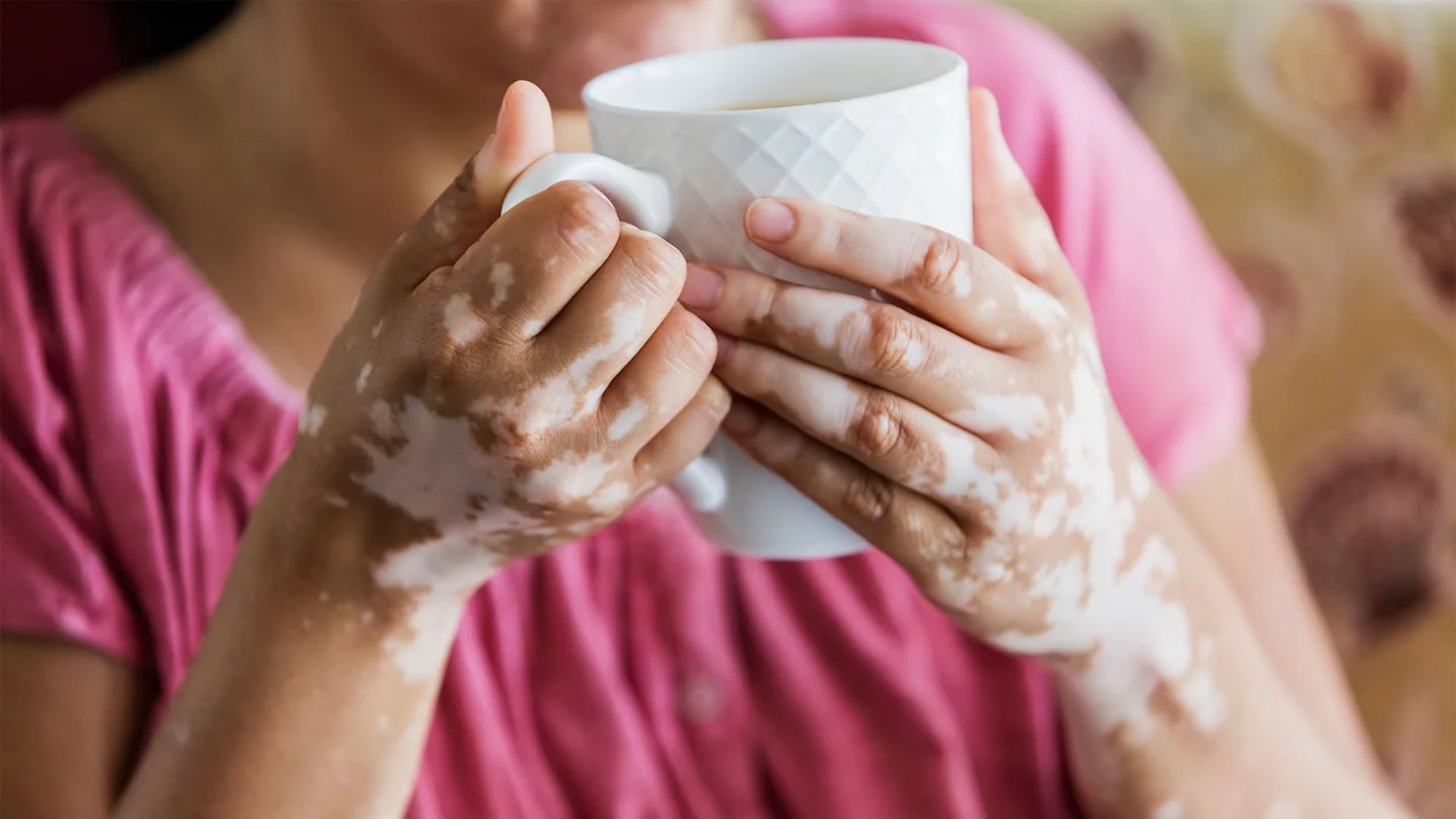Vitiligo: Eine Frau h&auml;lt eine Tasse mit beiden H&auml;nden. Ihre ansonsten pigmentierte Haut hat weisse Flecken an H&auml;nden und Unterarmen.