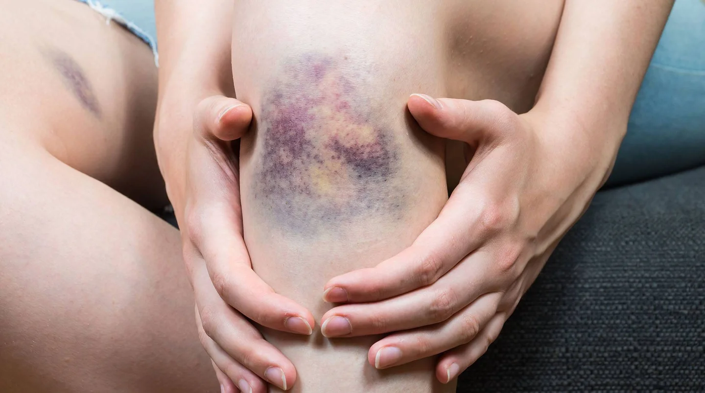 Großes Hämatom am Knie