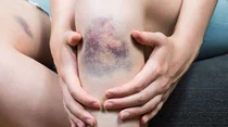 Großes Hämatom am Knie