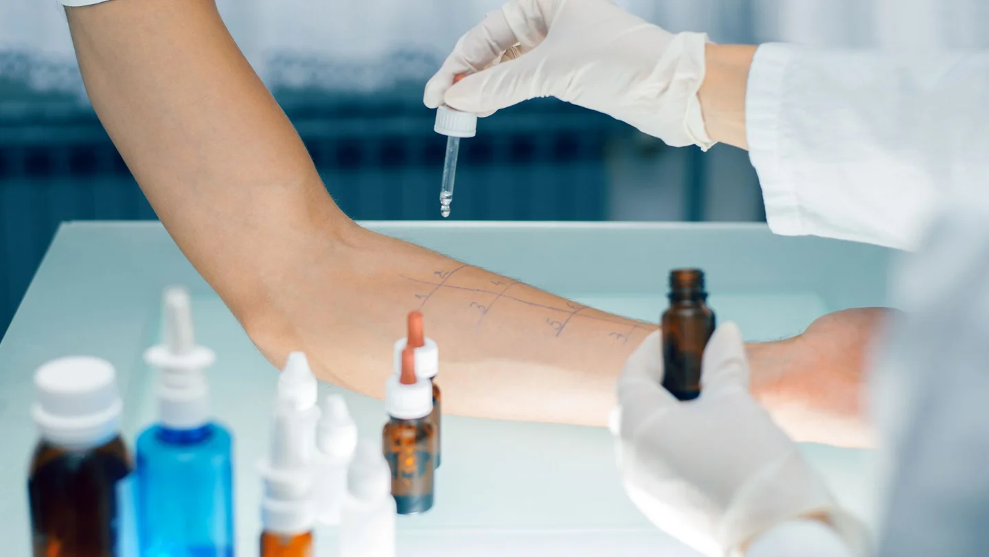 Ein Arzt tr&auml;ufelt mit einer Pipette Fl&uuml;ssigkeit auf den Unterarm eines Mannes. Auf dem Arm sind Linien und Testfelder aufgezeichnet.