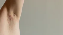 R&ouml;tliche Ver&auml;nderungen unter der Achsel eines Patienten mit Akne inversa. 